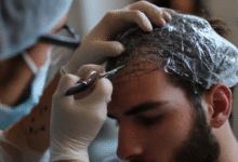 Hair Transplant Surgery