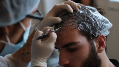 Hair Transplant Surgery